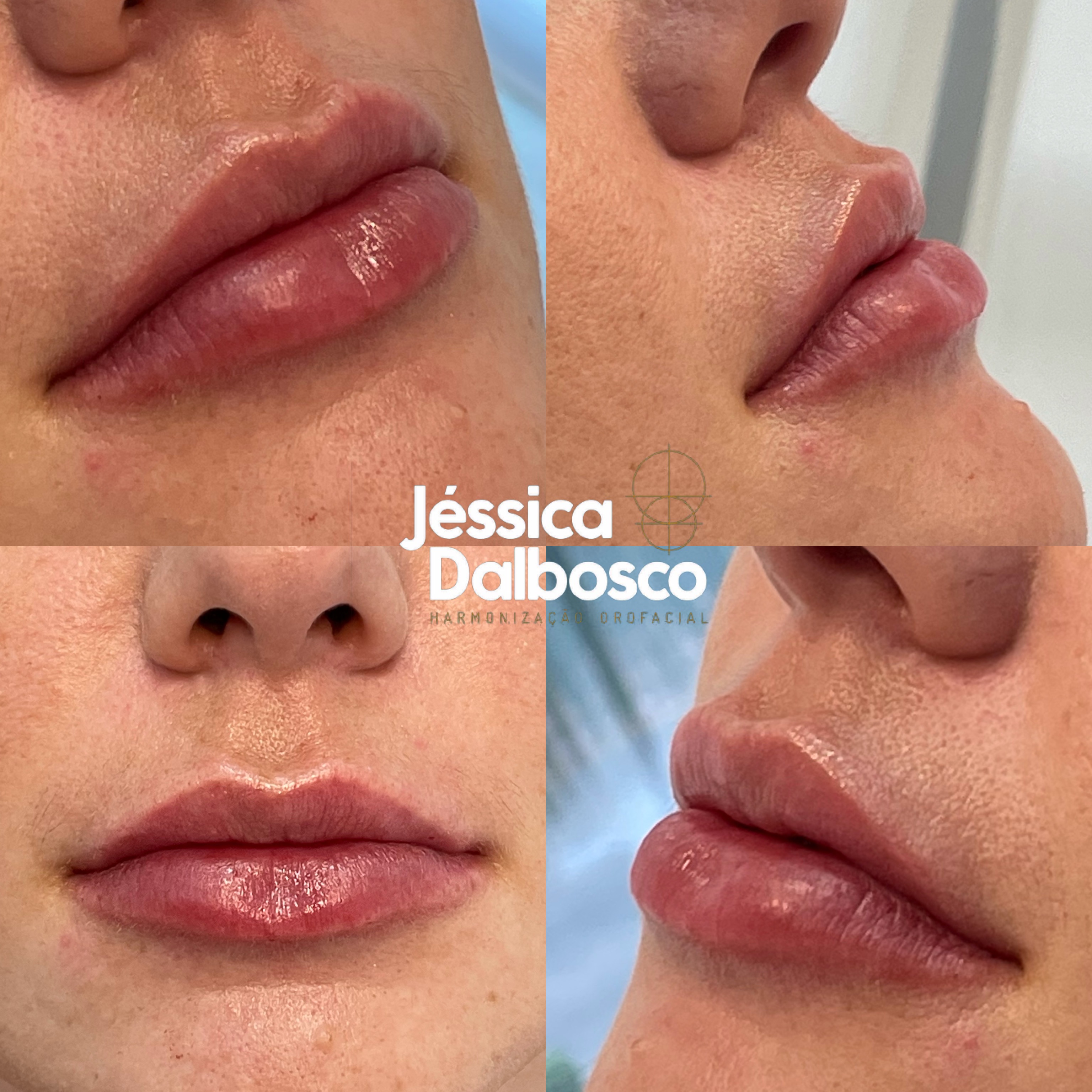 Preenchimento labial