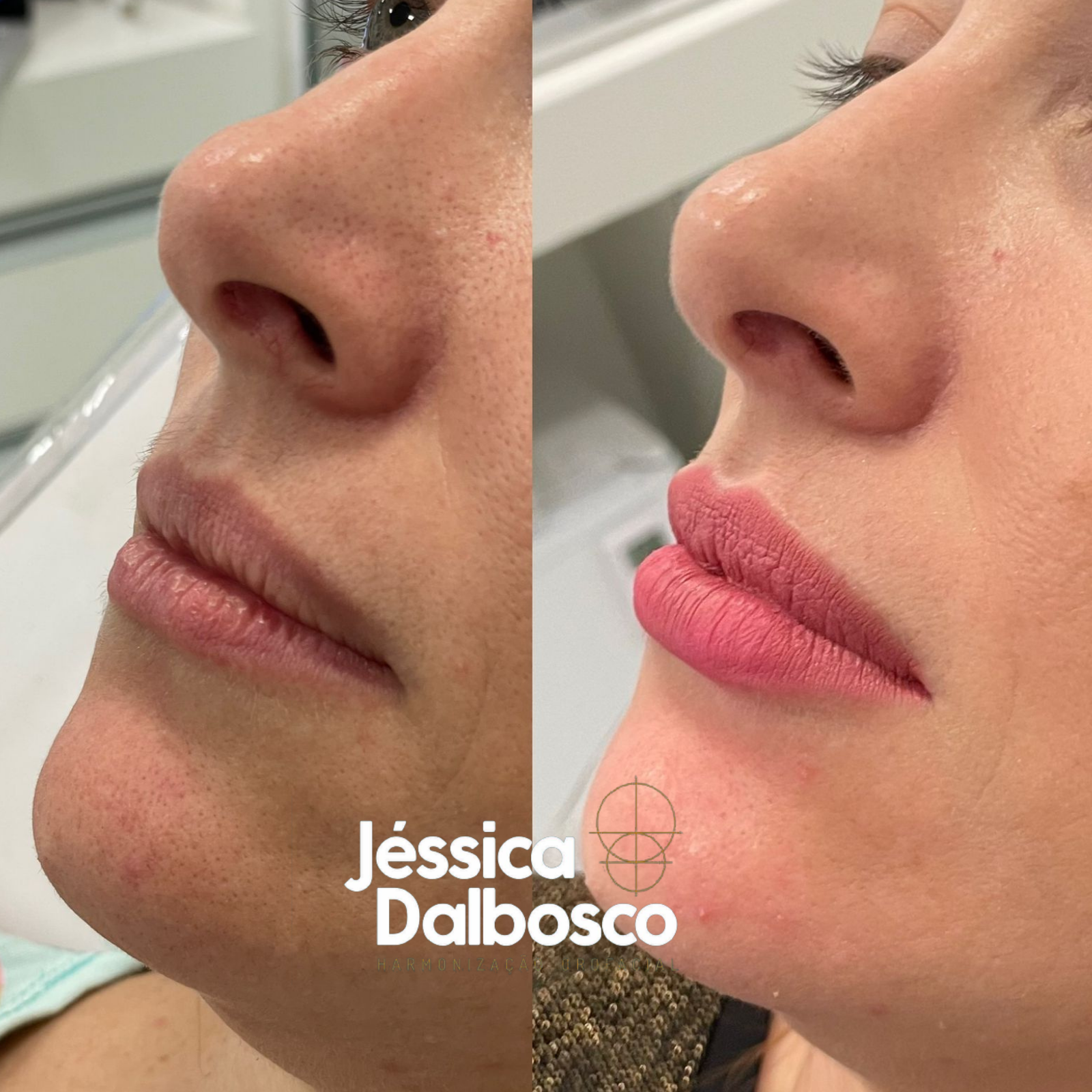 Preenchimento labial