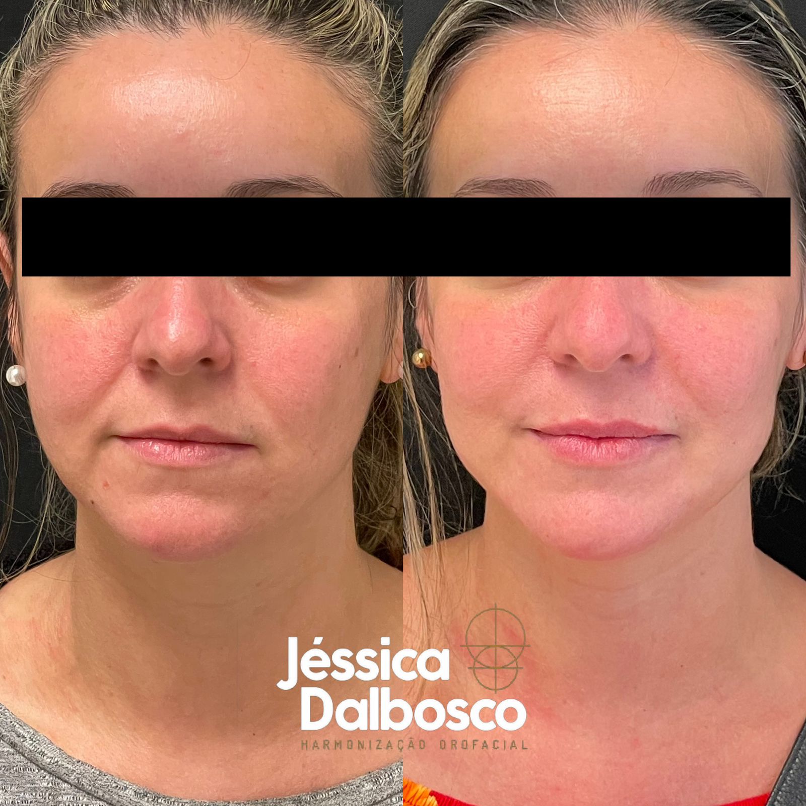 Bioestimulador de colágeno Sculptra